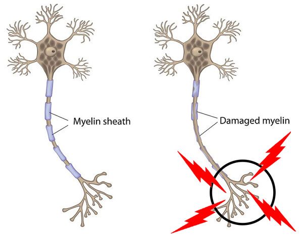 nerve irritation due to myelin sheath damage.